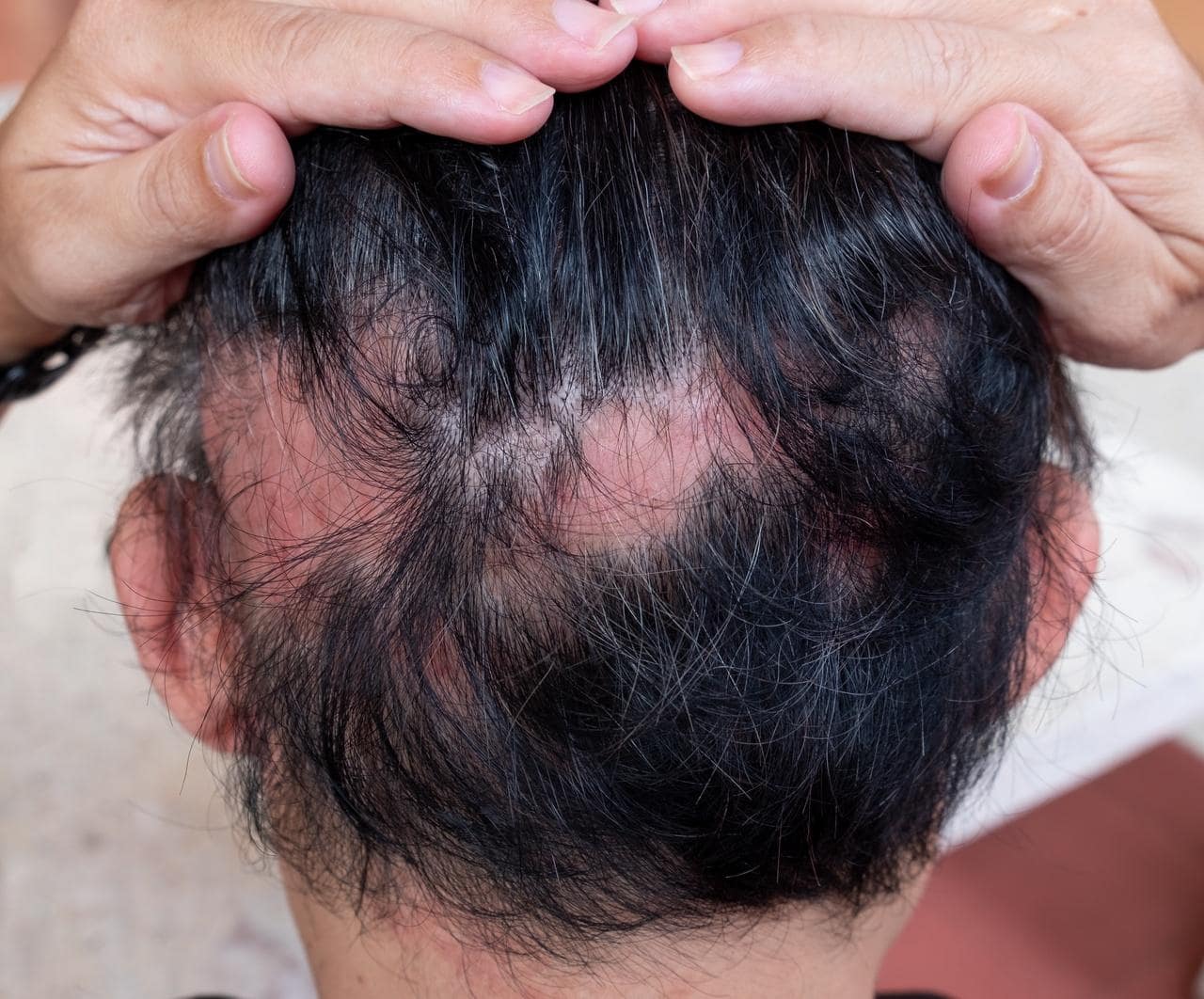 Alopecia areata