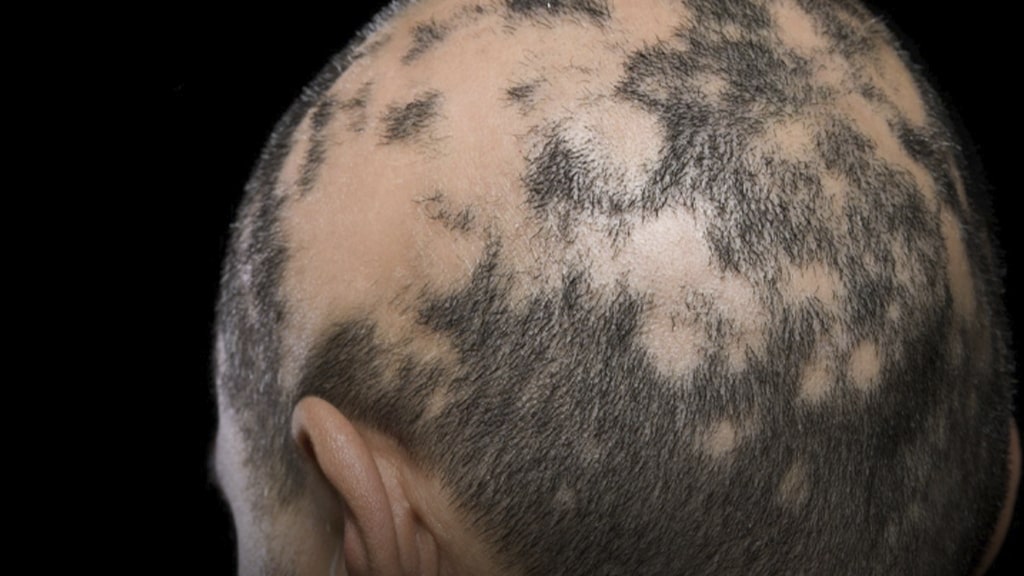 Alopecia areata