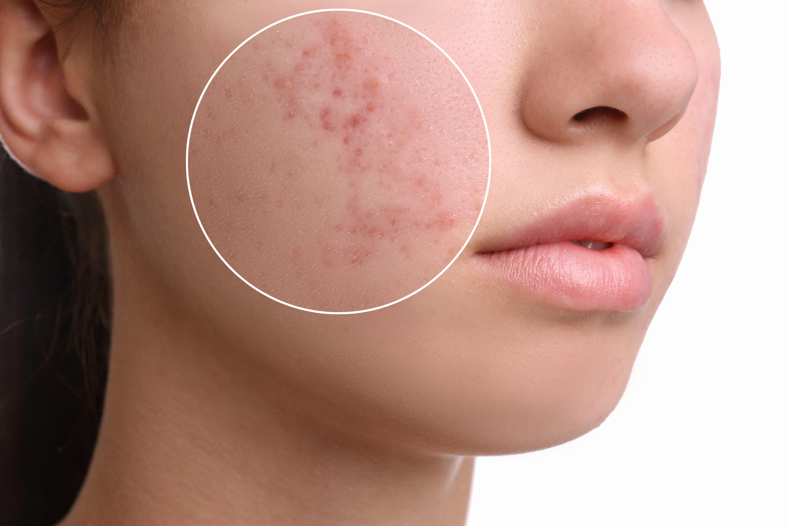 Influenciadora mostra rotina com acne grave; conheça a doença, as causas e os tratamentos